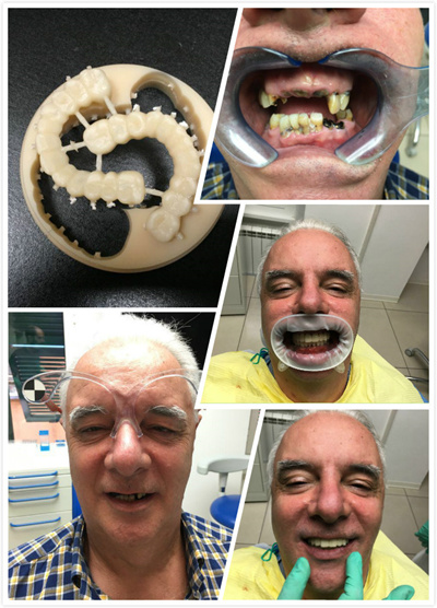Dental PEEK material(图1) Material dental Peek(pic1)