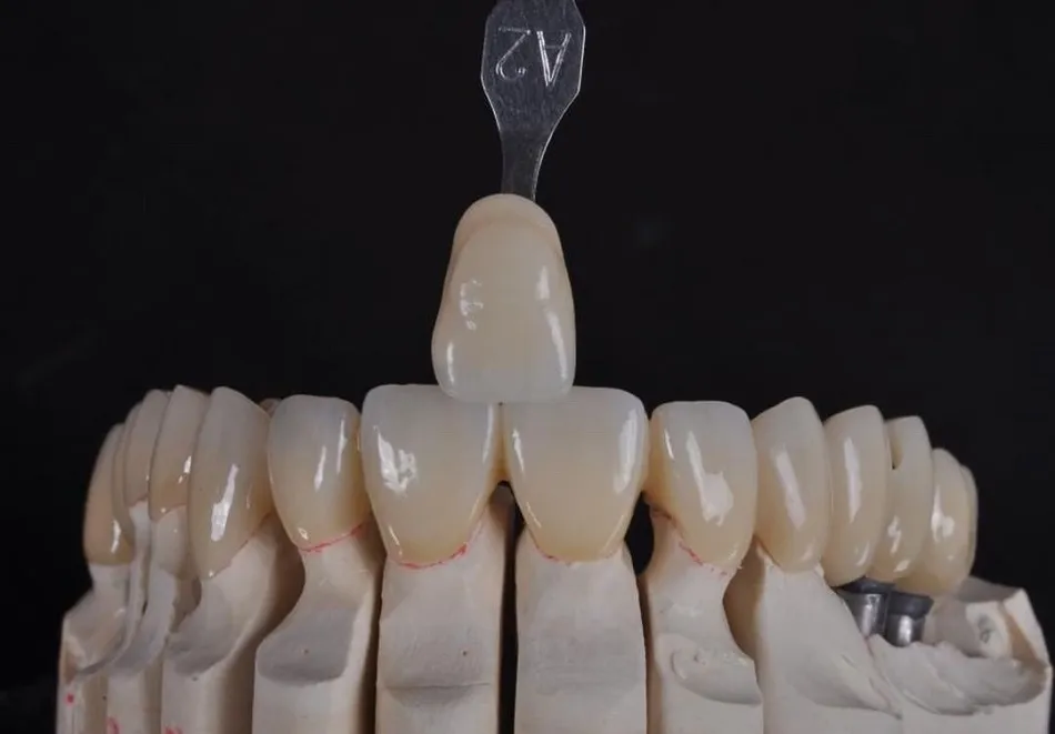 Points of Zirconia Crown Preparation Design(图2)