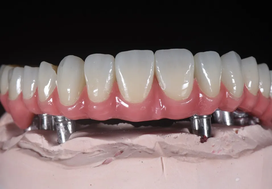 Points of Zirconia Crown Preparation Design(图3)