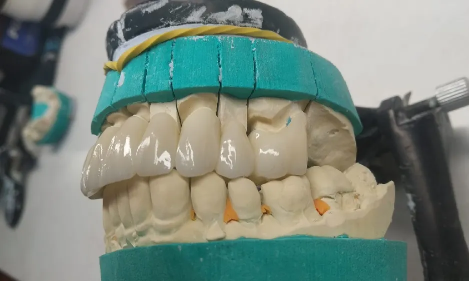 Points of Zirconia Crown Preparation Design(图4)