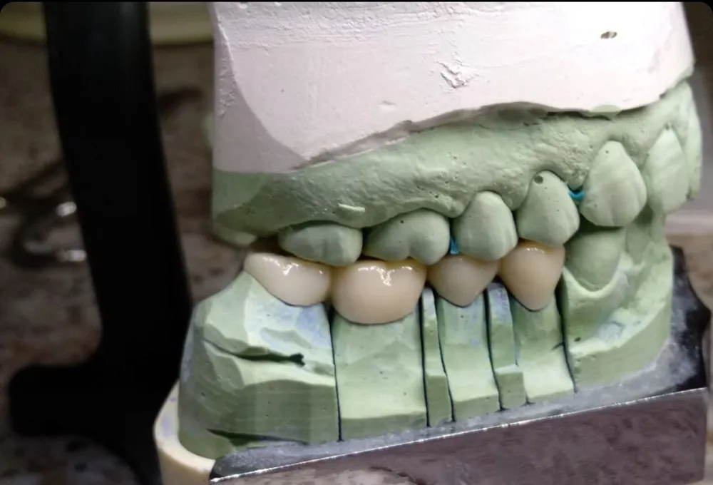 Pick Your New Crown: Zirconia and Gold(图3)