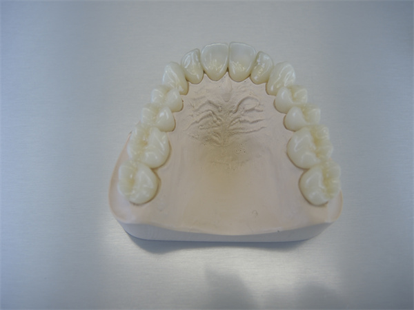 Comparison of Dental Bridges and Dental Implants
