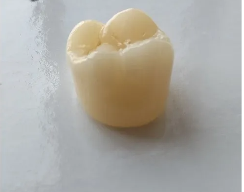 Comparison of Dental Bridges and Dental Implants(图2)