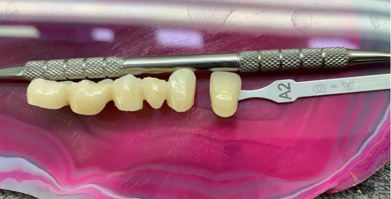 Unique Benefits of Zirconium and Zirconia Crowns(图2)