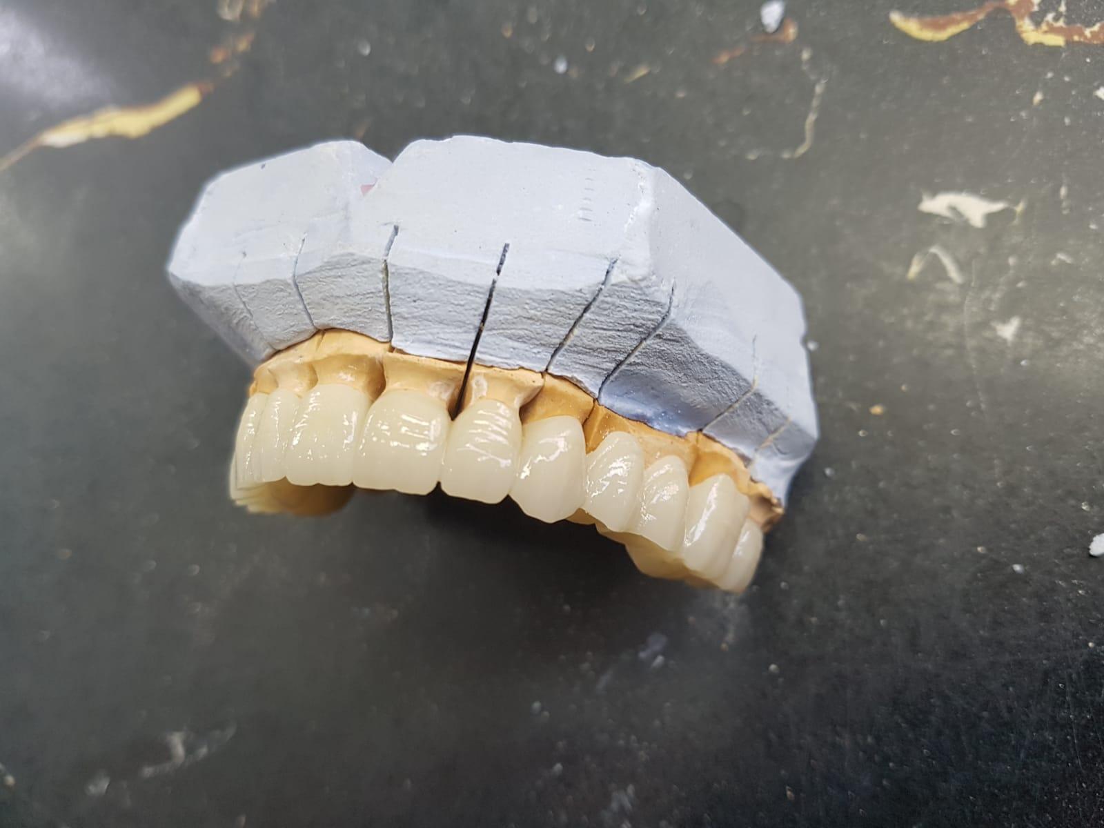 The Dental Restoration Process and the Praise of Our Clients!(图2)