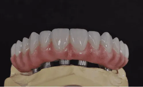The Dental Restoration Process and the Praise of Our Clients!