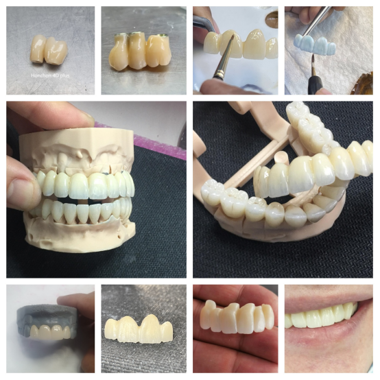 The Benefits of Multilayer Zirconia Crowns: