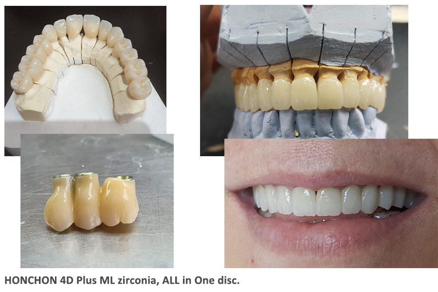 4D plus ML zirconia case.jpg ¿Cómo aprender rápidamente sobre nuestros bloques de zirconia dental(pic5)