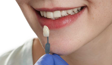 3 Key Points You Must Know About Zirconia Crowns