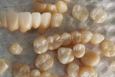 What is the thickness of the preparation for zirconium dioxide all-ceramic teeth?(图1)