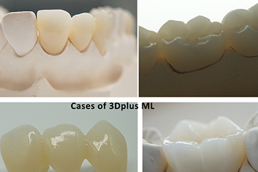 Talking About the Inlay Repair Technology of Contemporary Tooth Defects(图1)