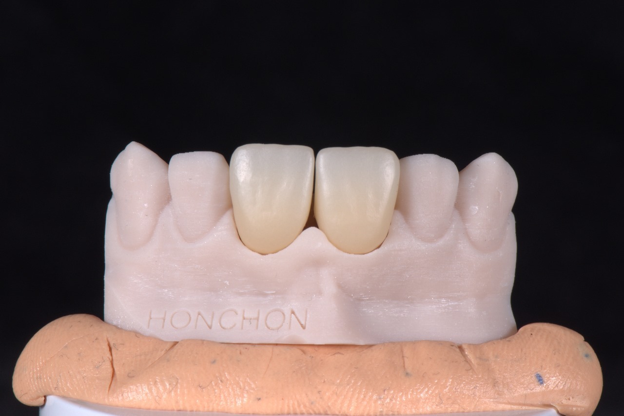 Multi-layer gradient zirconia ceramic blocks that combine function and aesthetics