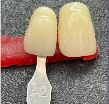 Multilayer dental zirconia blocks: material innovation and clinical application explained(图1)