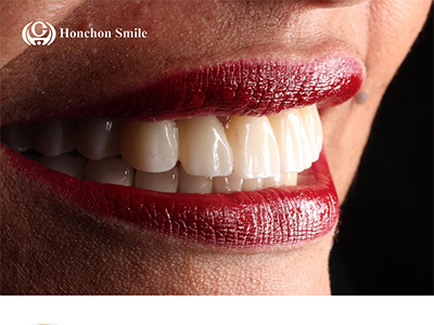 Zirconia Dental Crowns: Strong, Natural, and Built to Last