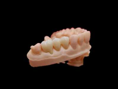 Factors Affecting Fixed Denture Restoration – High-Precision Materials for Dental Labs