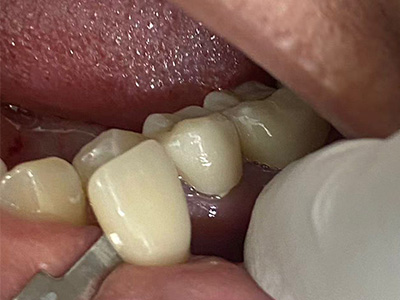 Why Zirconia Blocks from Different Manufacturers Show Color Differences After Sintering