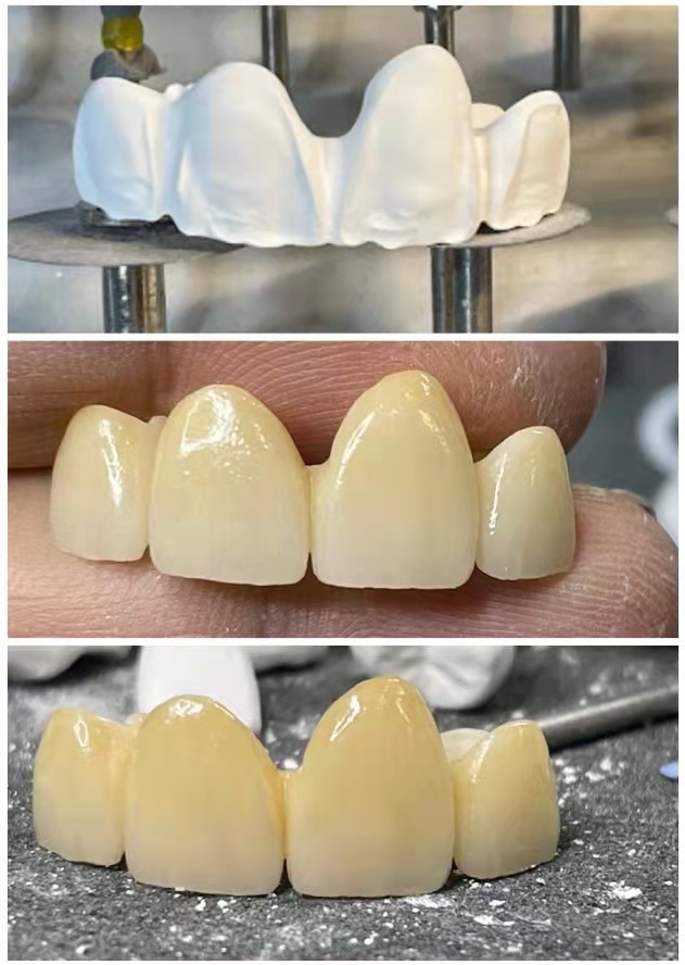 meilleurs blocs de zircone(pic2)